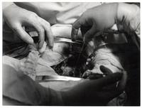 Operación al corazón, doctores Borzone y Escobar, Hospital El Salvador